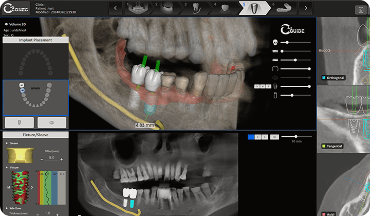 환자의 구강 상태를 철저히 분석하고 최적의 임플란트 치료방법을 제시합니다