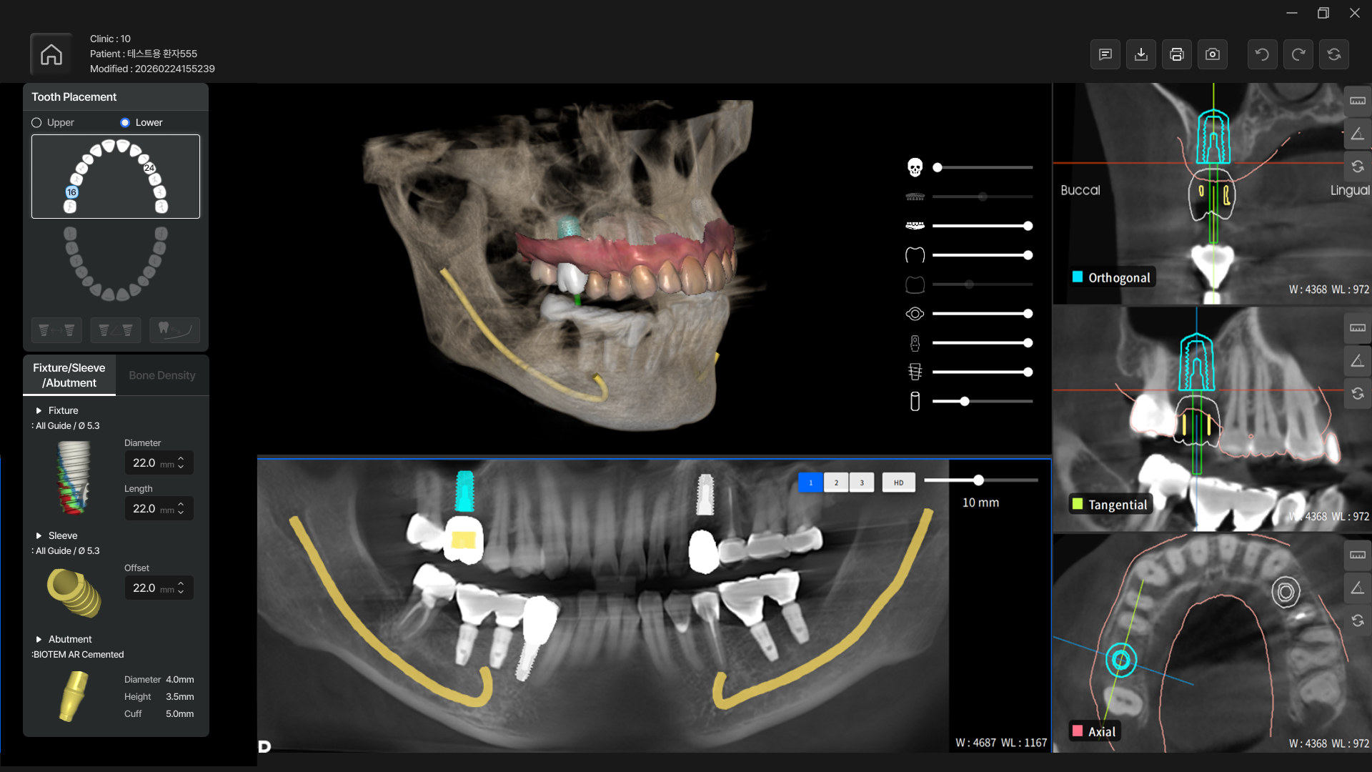 Fast and precise implant planning is possible based on 3D data.